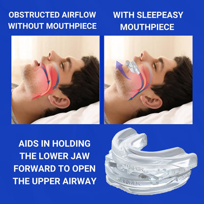 Silent Sleep | Mouth Guard for Snoring with Adjustable Fit | Enhance Sleep Quality for Restful Nights 5